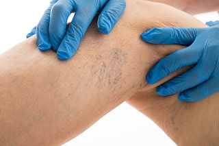 Spider veins on leg.jpg