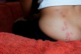 Bed bug bites on skin showing a line of red itchy welts