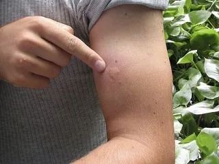 Mosquito bite on skin