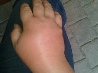 Bee sting