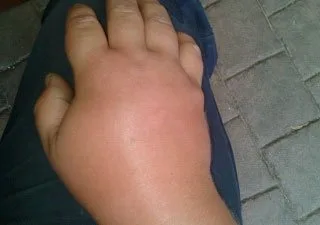 Wasp sting treatment